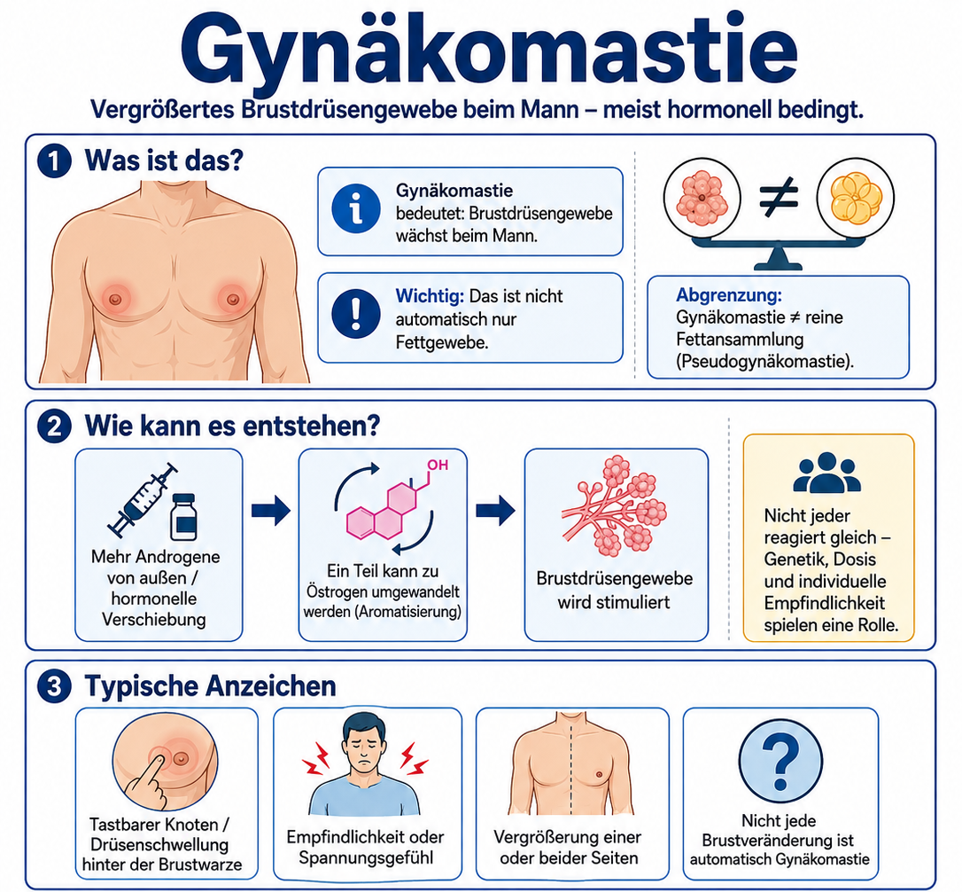 Eine Gynäkomastie ist eine von vielen möglichen Folgen einer exogenen Testosteronzufuhr